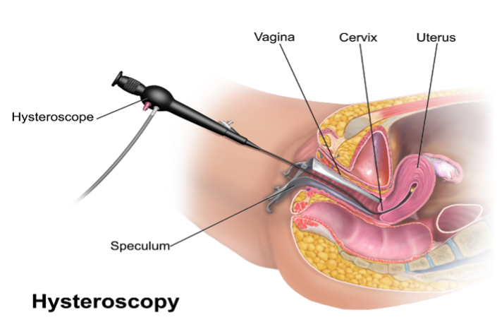 Histeroskopija
