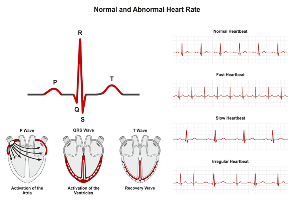 Poremećaji srčanog ritma