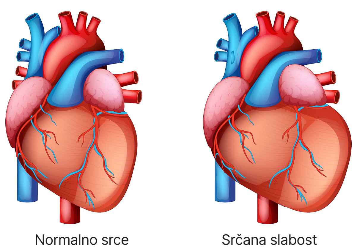 Angina pectoris